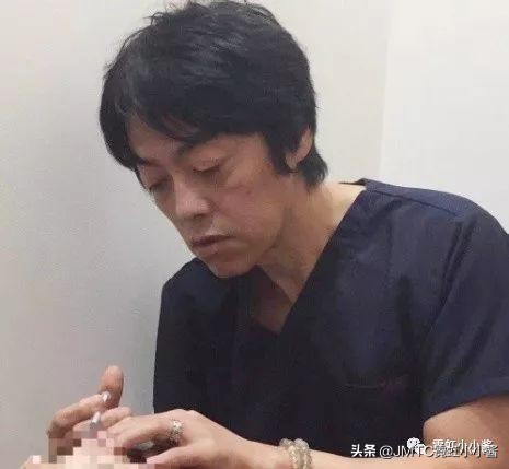 记录翻译小姐姐日本打溶脂针,肉脸变骨感脸全过程|日本医美