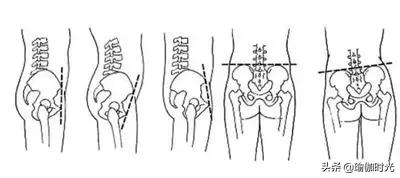 晚上盆骨疼缓解操,骨盆矫正运动操