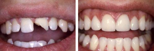 前牙折断修复流程,前牙摔断了咋修复