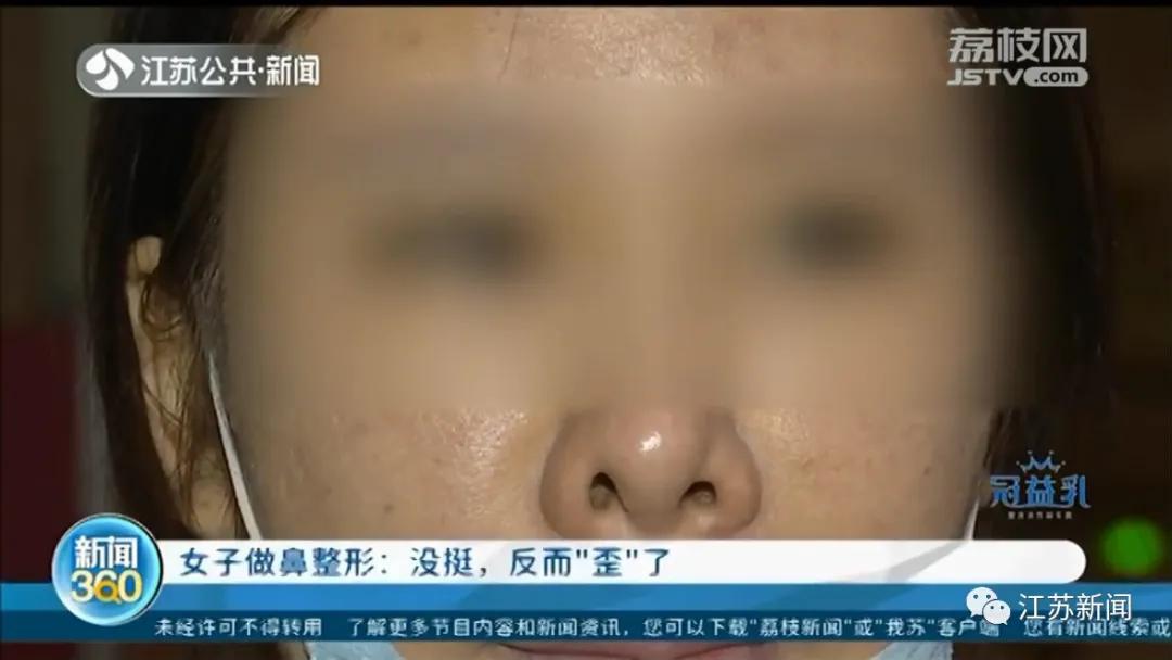 整容鼻子歪了真实案例,女子整容嘴变歪后来怎么样了