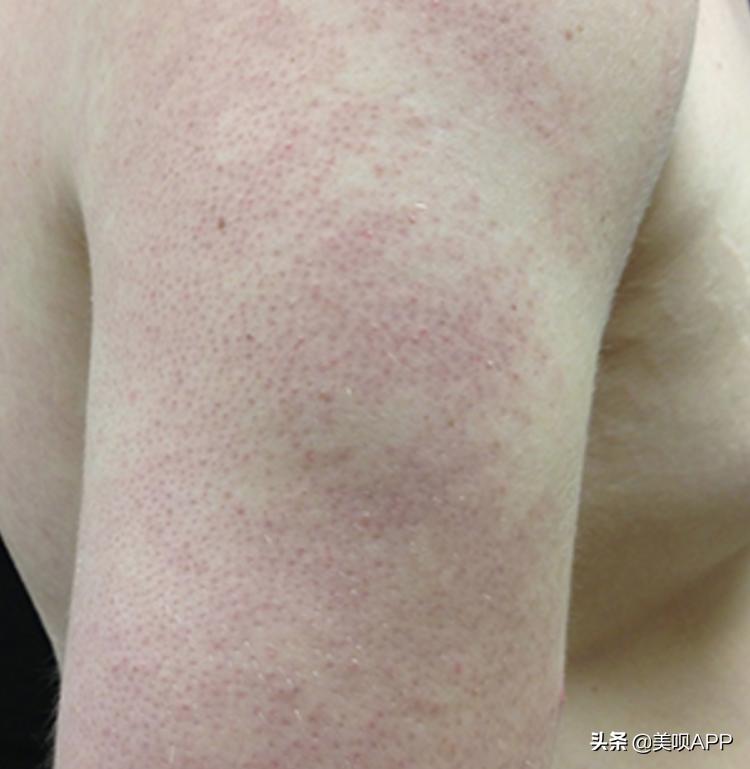 春季鸡皮肤大作战!去毛周角化也要分种类好吗?