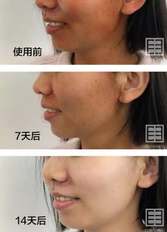 火到断货的“明星级”点斑笔，坚持每天点一下，14天养成初恋脸