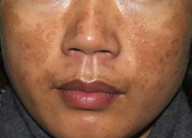 治疗褐斑妙方,褐青色斑不治疗还会再扩大吗