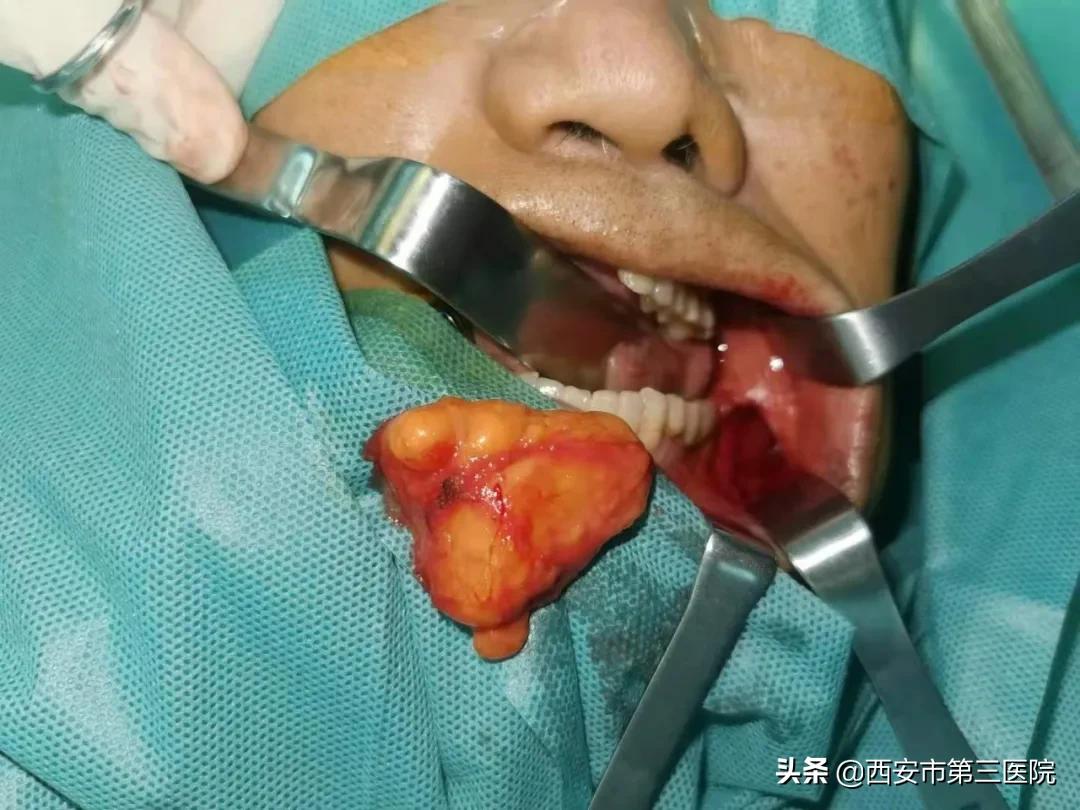 脂肪瘤的美容切除|解除七旬老人20年的困扰