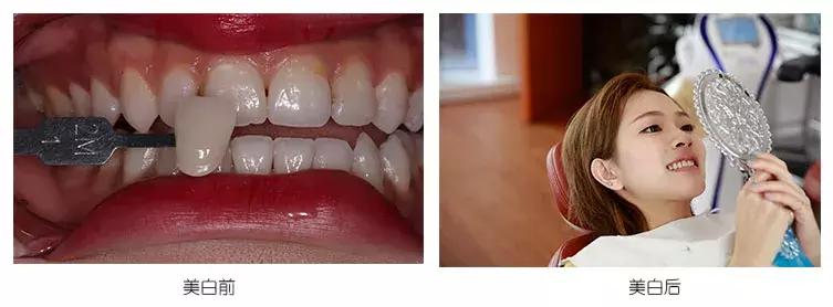 皓齿美白靠谱吗,做完皓齿美白牙齿特别疼