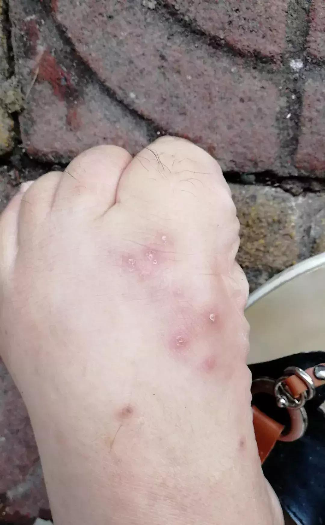 广西一女子被蚂蚁咬伤后不幸身亡,广西姑娘被一只蚂蚁咬到紧急住院