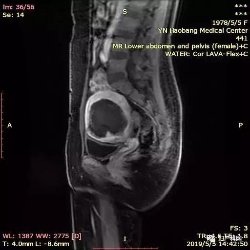 无症状子宫腺肌症可以不治疗吗,微无创超声介入