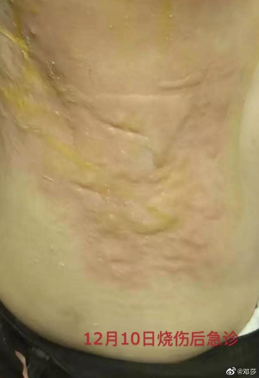 邓莎被烧伤原因,邓莎拔火罐被烧伤视频