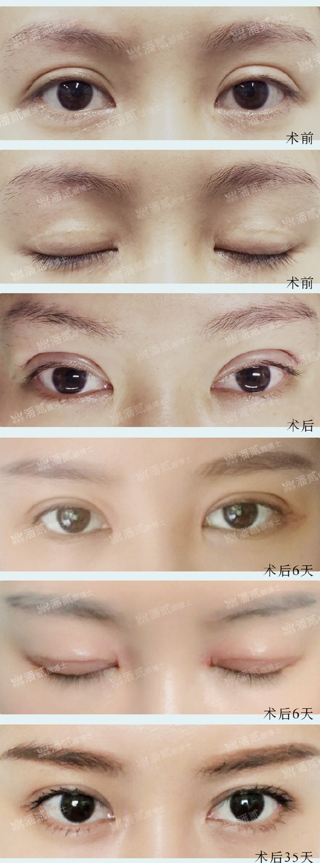 双眼皮修复有失败的吗,双眼皮修复失败了会怎样