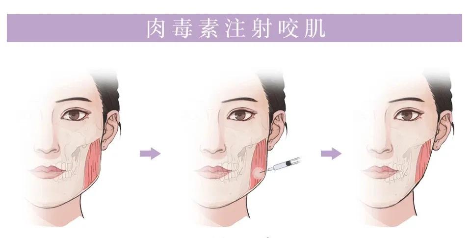 解密瘦脸针的几大常识性问题,关于瘦脸针的几个常识问题