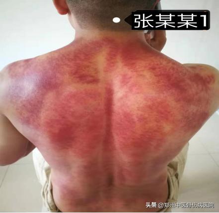 李氏砭法刮痧直播,李氏虎符铜砭刮痧治腰椎间盘突出