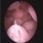 上海中医看子宫内膜息肉的专家,子宫内膜息肉名医