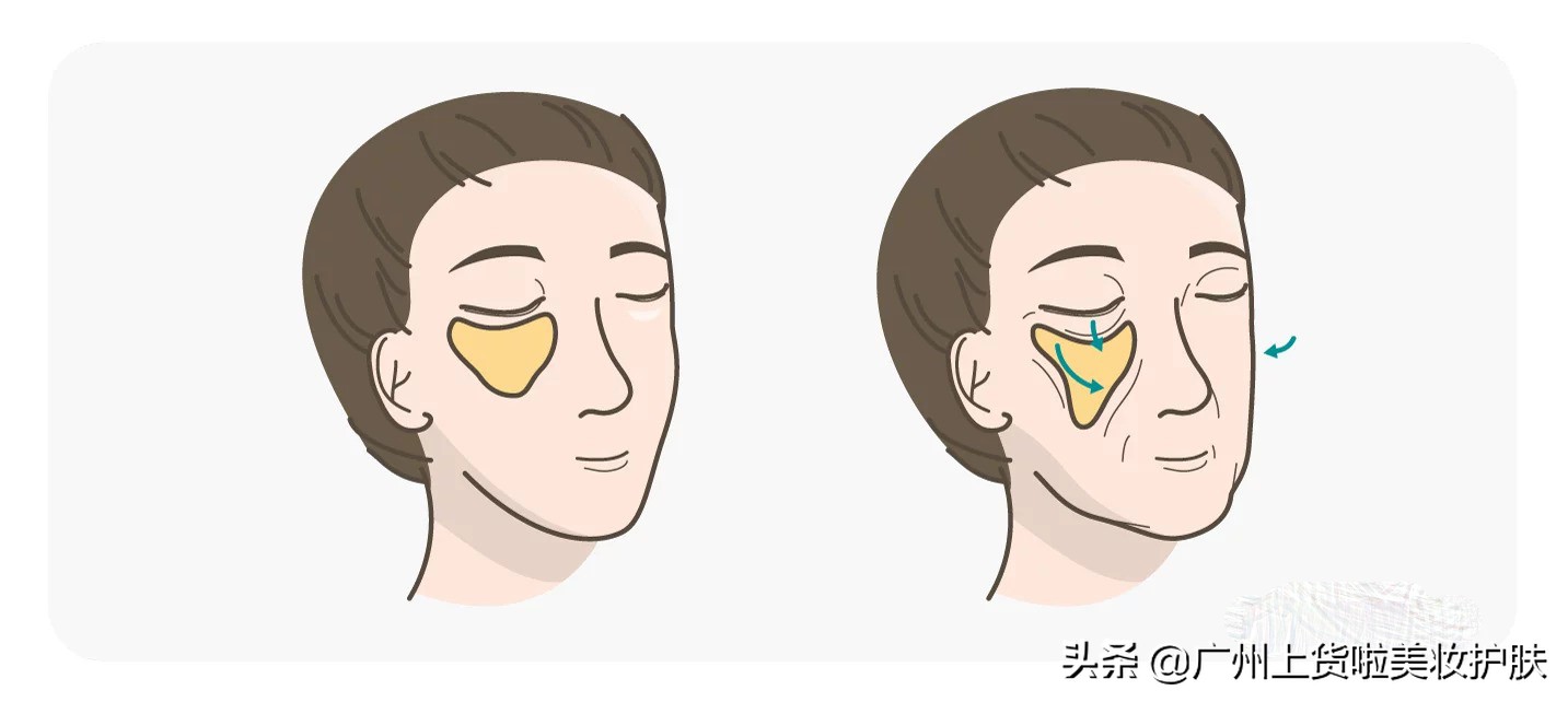法令纹比较深最有效的办法,法令纹的种类及改善方法