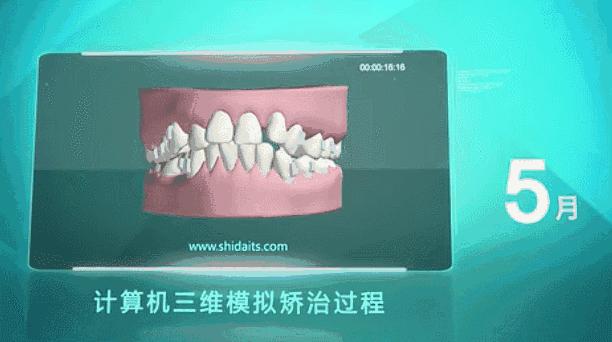 湖北种植牙齿多少钱一个,最新武汉种植牙齿多少钱一颗