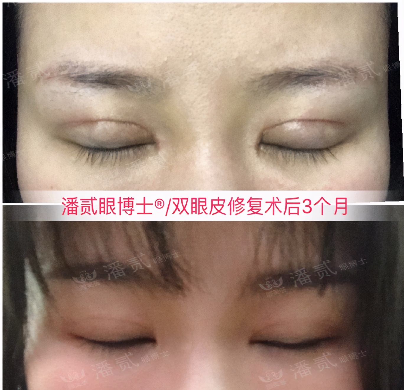 广州双眼皮凹陷修复视频,小切口双眼皮肉条修复