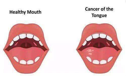 肿瘤医生科普：舌癌术后该如何进行语言康复训练？