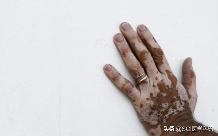 女子割双眼皮变白眉大侠,一女子割双眼皮变白