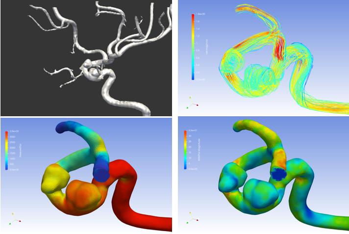 颅内动脉瘤需要放支架吗,颅内动脉瘤夹闭术手术步骤
