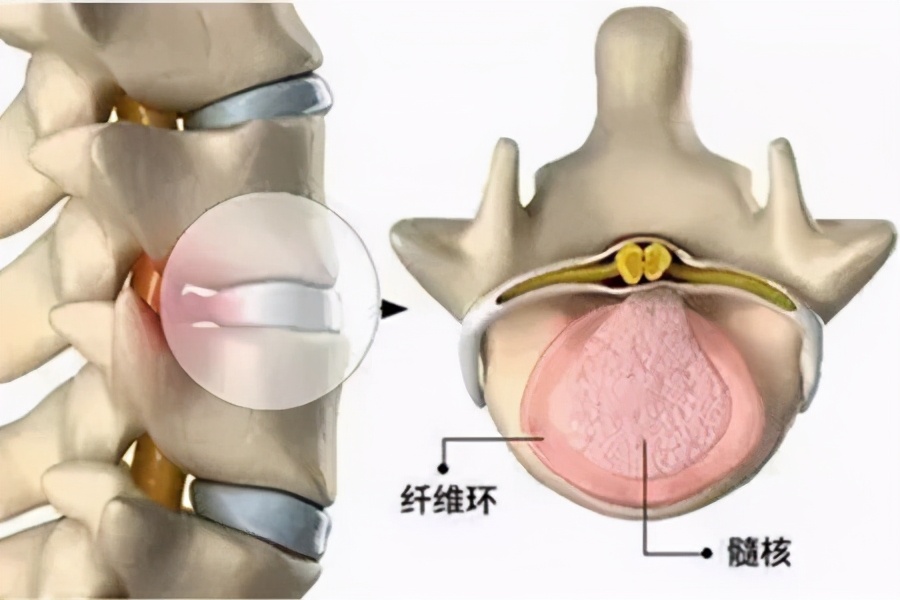 强直病友应该如何进行康复训练,强直后期怎么治疗