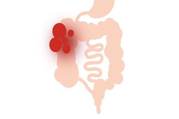 痰是怎么形成的怎么祛痰,痰是怎样产生的怎样去除