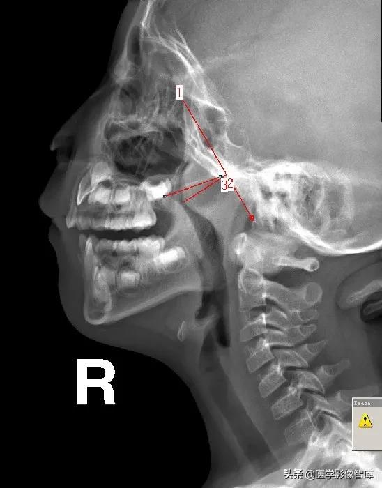 腺样体肥大有必要做x射线复查吗,最简单检测腺样体肥大的方法