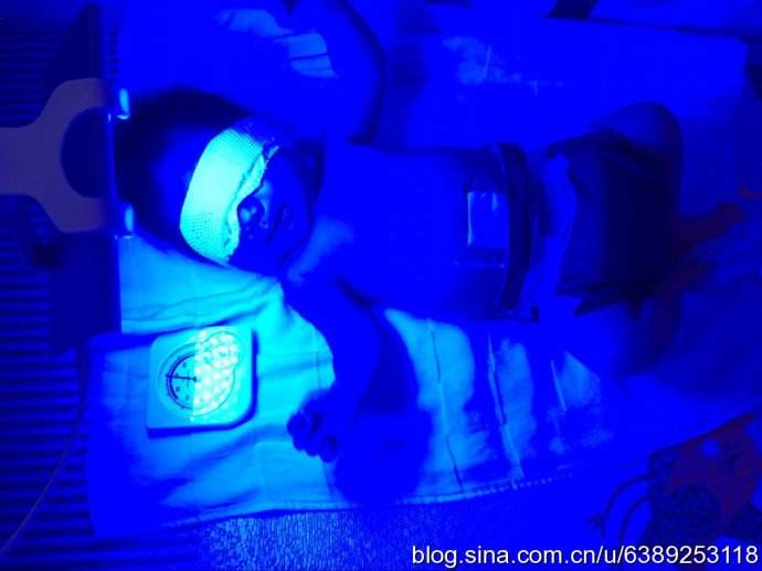照完黄疸后宝宝拉黄便正常吗,照了蓝光出院宝宝是不是就安全了