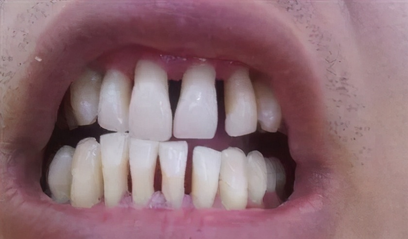 年纪轻轻的掉牙齿是怎么回事,年纪轻轻牙齿掉了