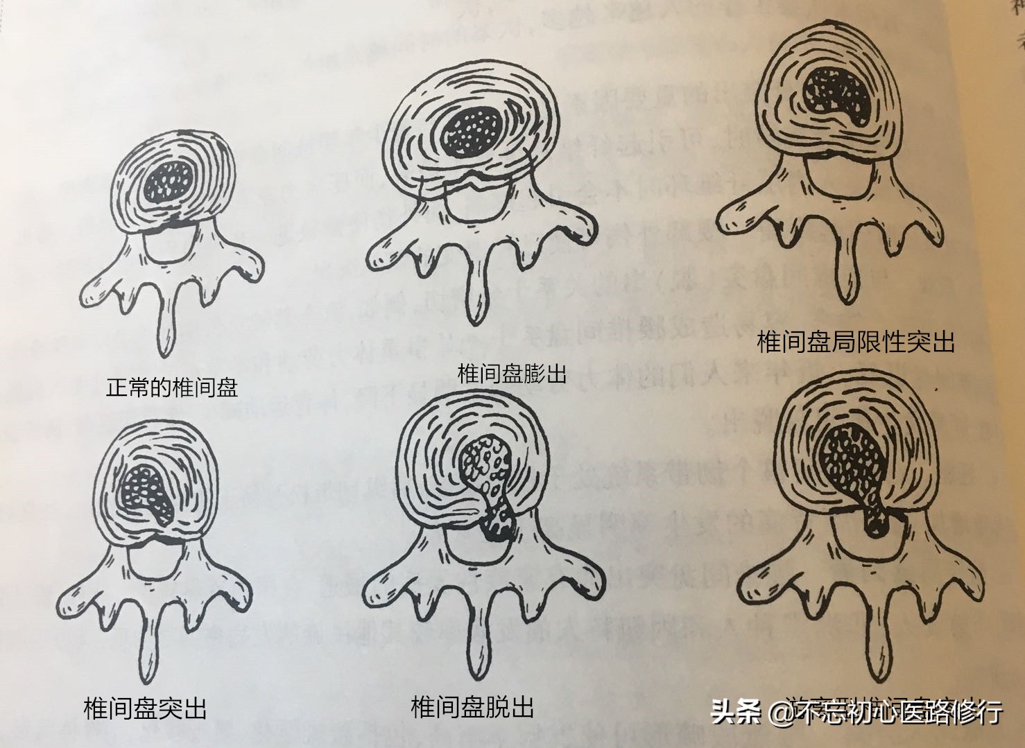 治疗腰椎间盘突出的方法与思路,腰椎间盘突出腰腿酸痛多久能好