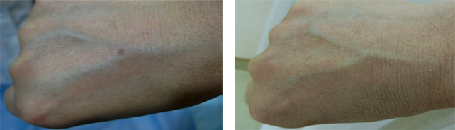 激光美容项目有哪些,激光美容有哪些项目