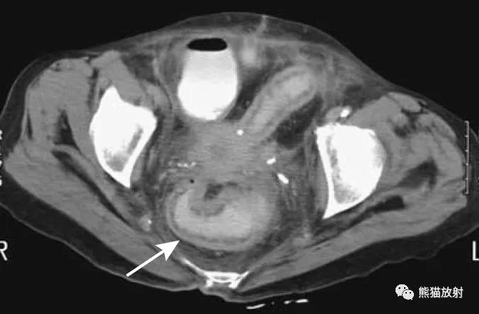 腹部影像图片大全,乙状直肠疼痛位置图片