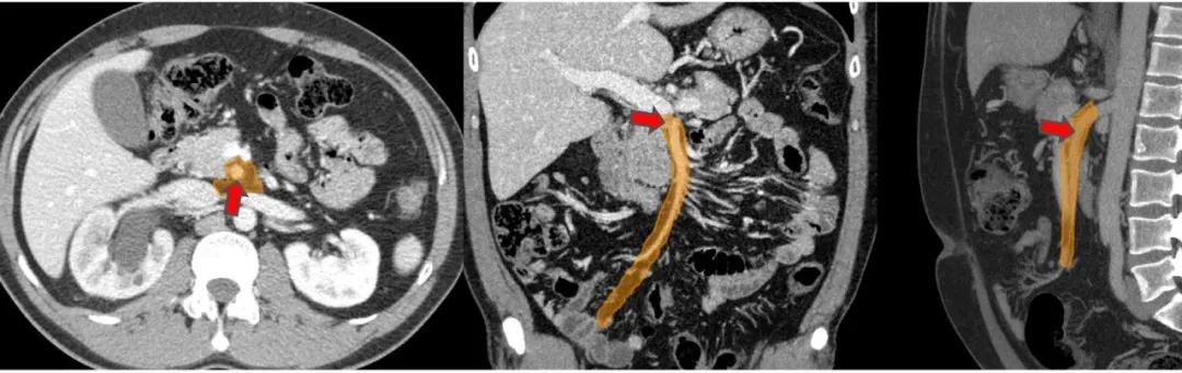 这样的解剖结构容易忘？重新认识肠系膜