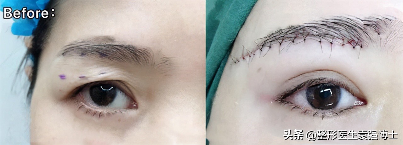 提眉手术拆线疼不疼,提眉手术20多天了怎么还感觉疼