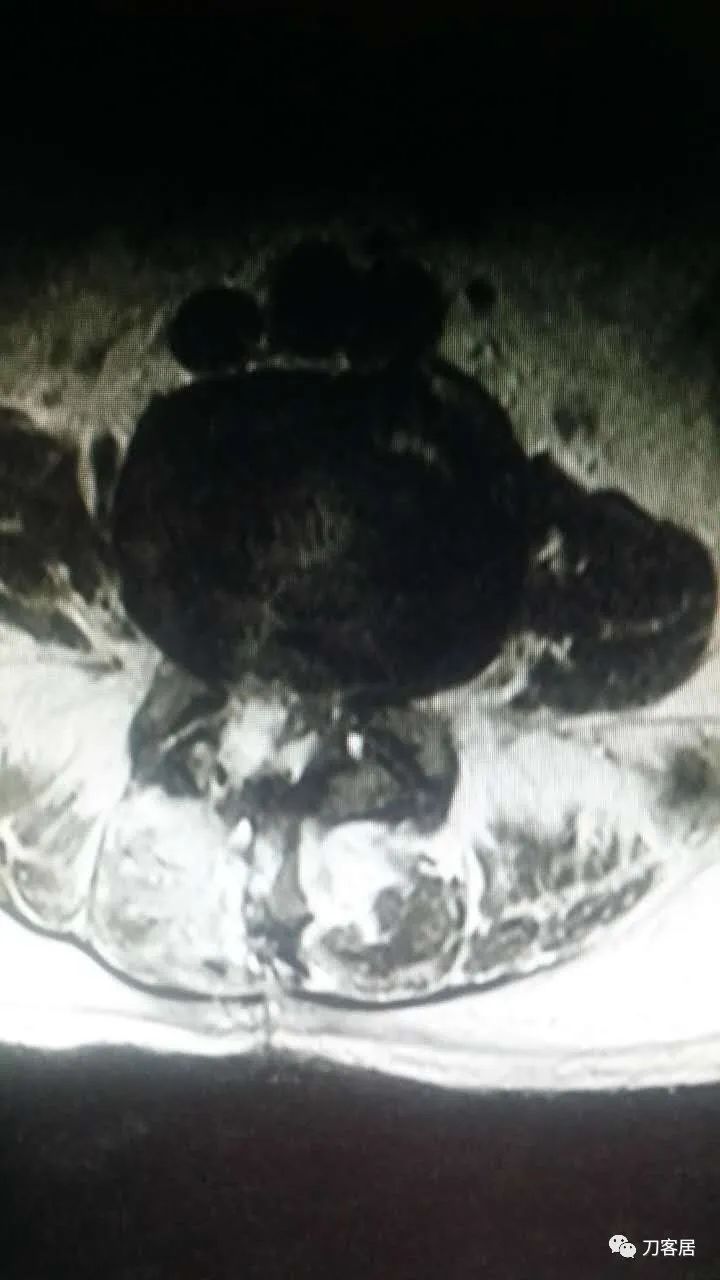 腰椎手术切掉棘突,腰突微创后出血肿