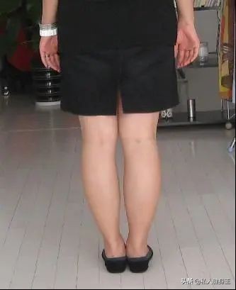 5种肥胖症状的减肥攻略,六种肥胖