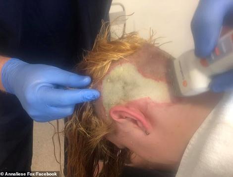 烧伤取头皮植皮,自己漂头发失败能再染吗