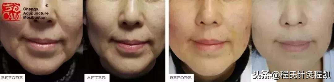 不要在脸上动任何刀,不要轻易在脸上动刀