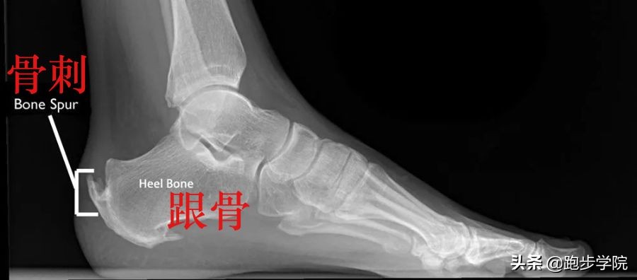 跟腱炎发病处理,跟腱炎如何治疗才能恢复