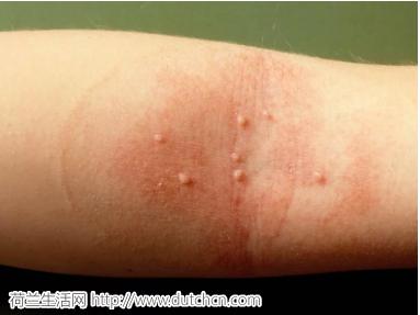 全球十大毒毛虫,毒毛虫的刺引起全身过敏