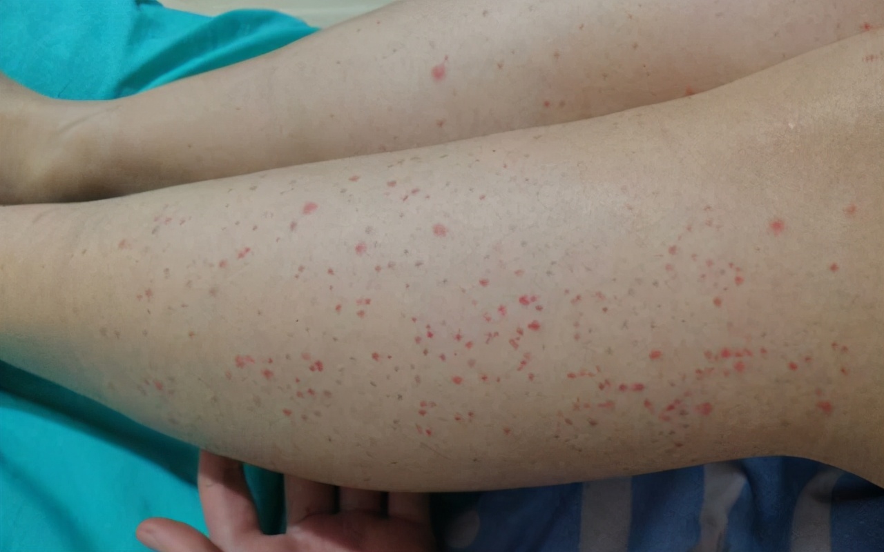 新冠疫苗接种后会紫癜吗,打了新冠疫苗后得了紫癜