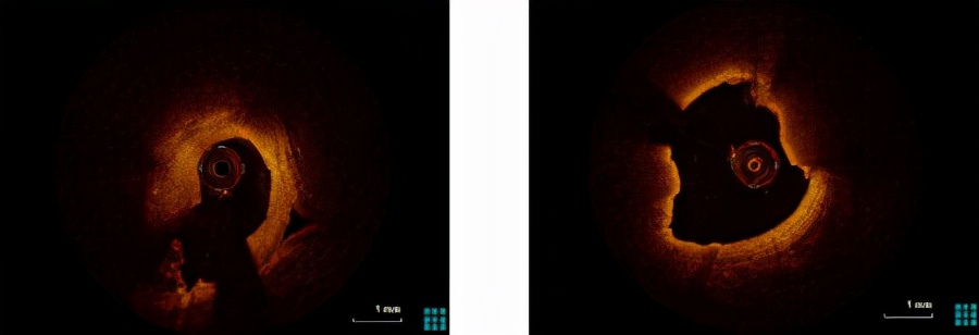哈医大二院完成静脉桥血管再狭窄OCT指导下药物球囊介入治疗