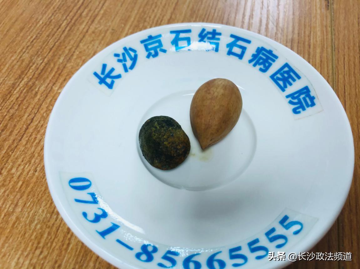 女子吃一周春笋后查出胃石症,胃病伴有胆囊结石