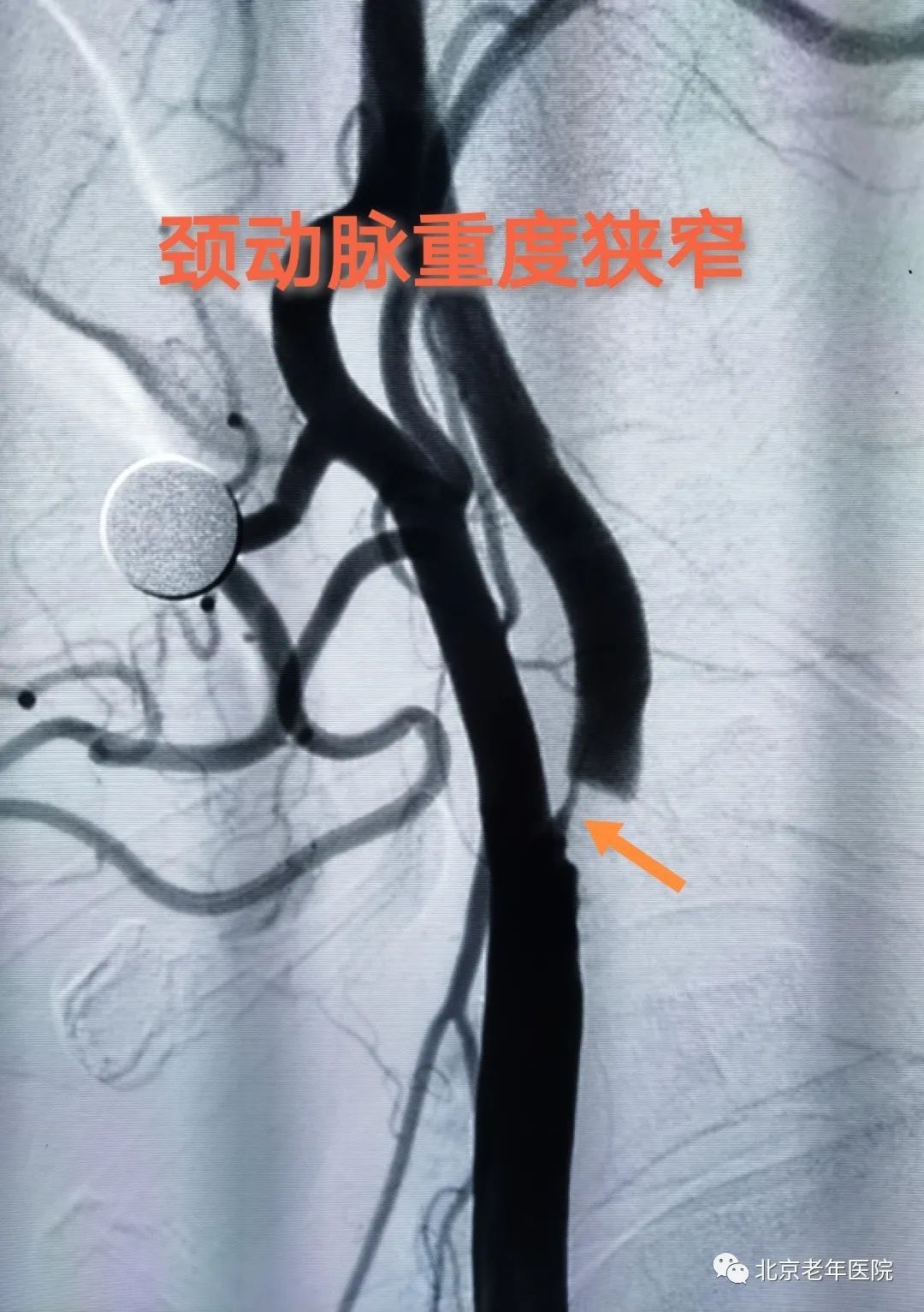 血管狭窄引起脑卒中需要下支架吗,80岁脑血管狭窄有必要做支架吗