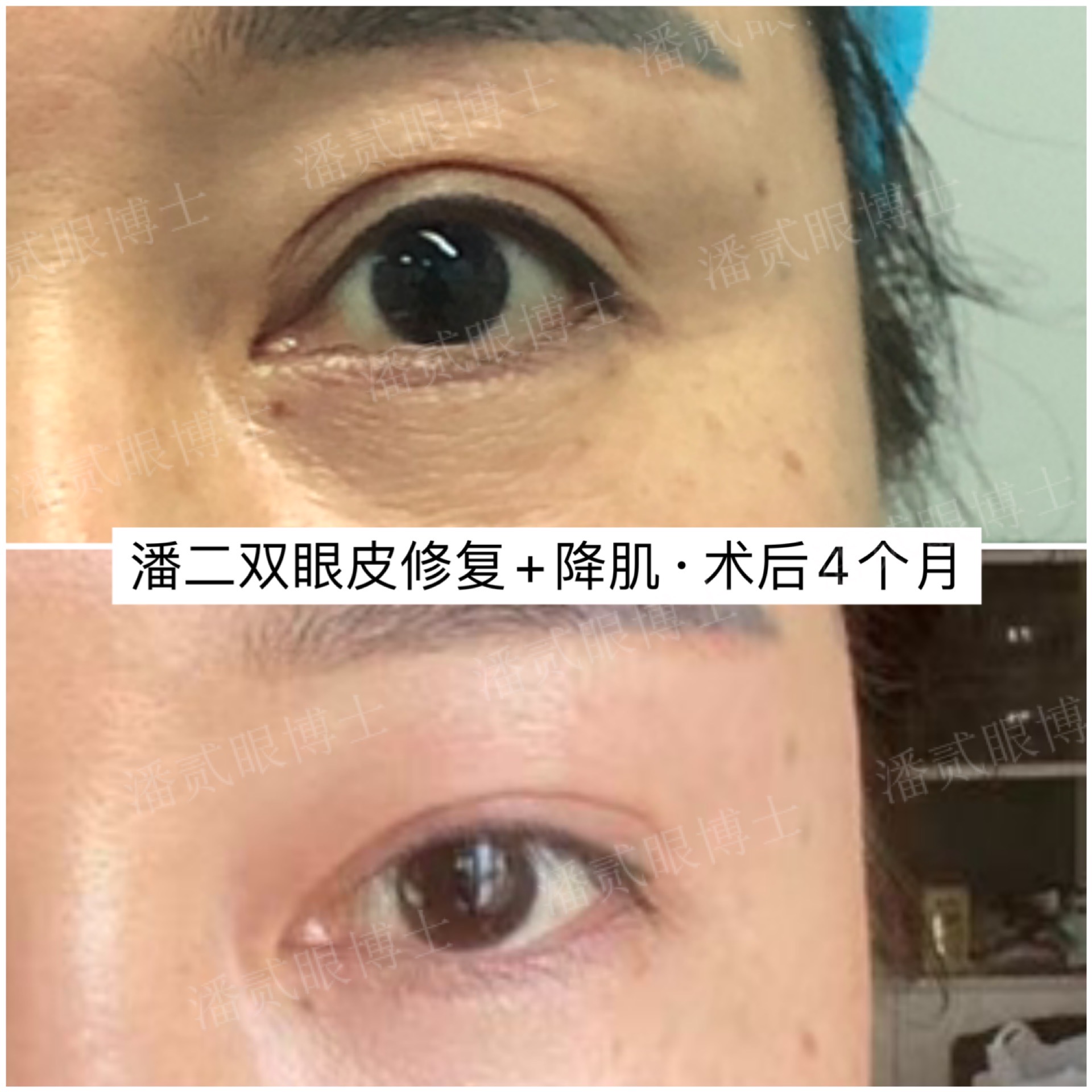 东莞做无痕双眼皮,东莞双眼皮修复