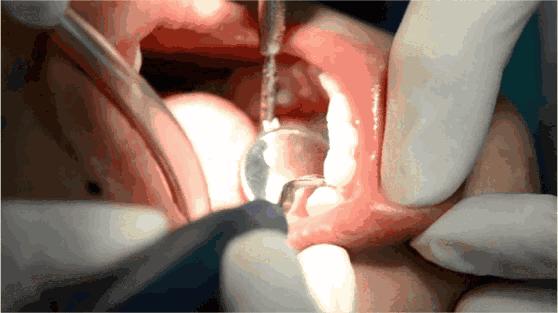 牙疼去看牙需要多久,牙疼的建议