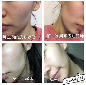 光了嫩肤后皮肤会变光滑吗,皮肤黑光子嫩肤10天变化图片