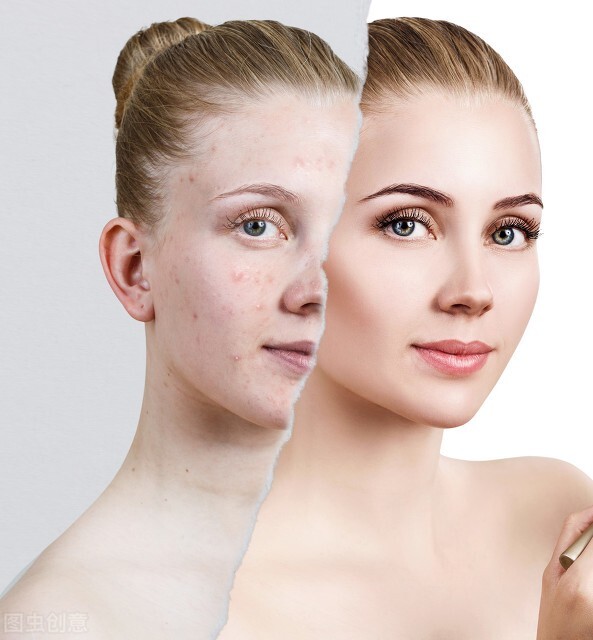 预防痘痘的日常小妙招,痘痘形成原因及缓解护理