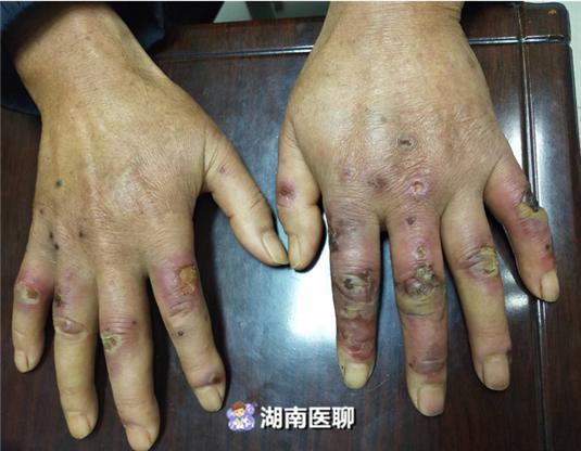 寒冷性红斑冻疮会自愈吗,寒冷性多形红斑误认为冻疮好治吗