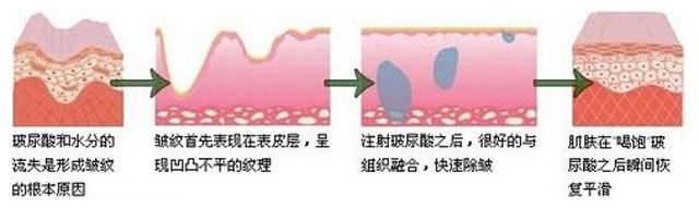 玻尿酸的效果,玻尿酸的美容优势有哪些