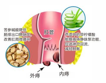 如果有轻微痔疮要怎么改善,得了痔疮不要怕食疗简单又方便