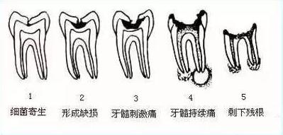 牙齿残根不疼不痒有必要拔除吗,牙齿残根可以不治疗吗
